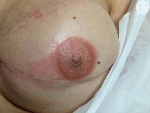 'A pele de uma mama mastectomizada traz com ela cicatrizes e diferenças no tecido, necessitando de diversas sessões para que haja uniformização de cor', explica May