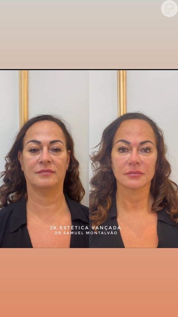 O Dr. Samuel Montalvão, responsável pela harmonização facial de Nadine Gonçalves, mostrou o antes e depois da mãe de Neymar