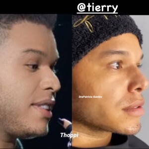 Em sua primeira sessão, Tierry fez alongamento no queixo e aplicou produto atrás da maçã do rosto