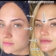 Drª detalha mudanças no rosto de Gabi Martins após harmonização facial