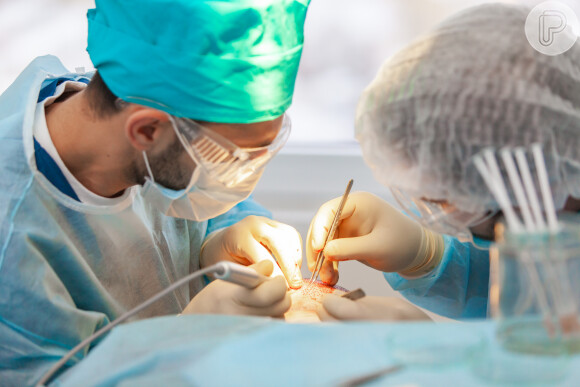 Transplante capilar sem anestesia geral