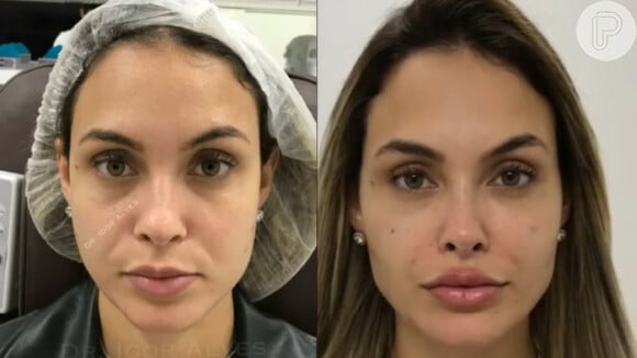 Famosos aderem à harmonização facial na internet e marcam clínicas de estética a assumirem mudanças