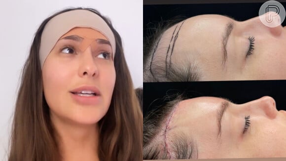 Thaís Braz faz cirurgia na testa para reduzir dois centímetros da área