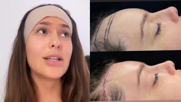 Thaís Braz faz cirurgia para diminuir 2 cm de testa e impressiona com antes e depois: 'Media 8 cm'
