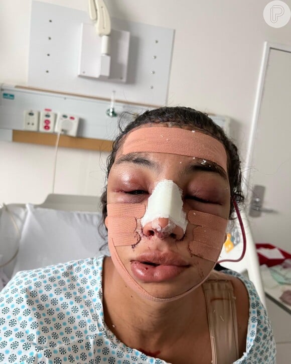 Linn da Quebrada mostrou o rosto logo após deixar a sala de cirurgia