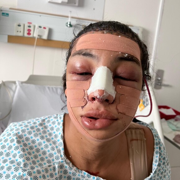 Linn da Quebrada mostrou o rosto logo após deixar a sala de cirurgia