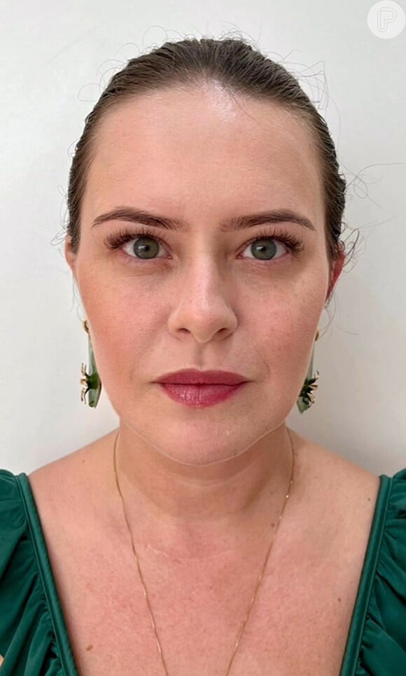 Após o procedimento, o rosto de Mariana Bridi ficou transformado