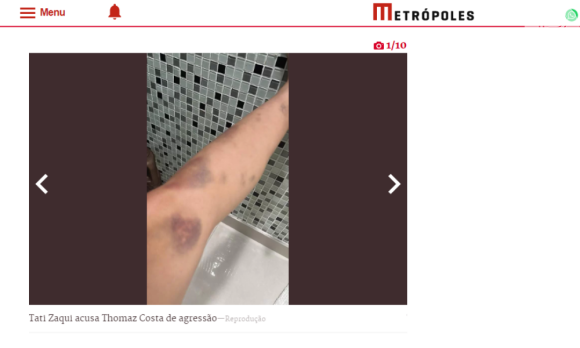 Tati Zaqui exibiu hematomas pelo corpo que teriam sido provocados por agressões de Thomaz Costa
