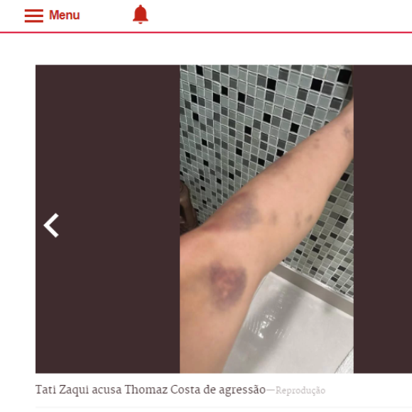 Tati Zaqui exibiu hematomas pelo corpo que teriam sido provocados por agressões de Thomaz Costa