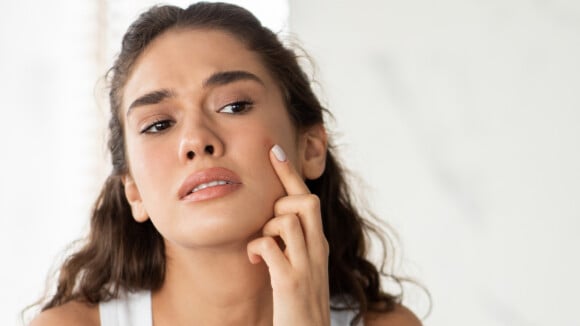 Nada de espinha: o que evitar quando se tem pele acneica? Saiba quais dicas e produtos que combatem a acne