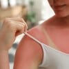 3 Dicas infalíveis para cuidar da pele queimada de sol e evitar o temido ardido