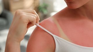 3 dicas infalíveis para cuidar da pele queimada de sol e evitar o temido ardido