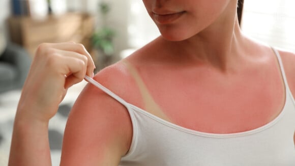 3 Dicas infalíveis para cuidar da pele queimada de sol e evitar o temido ardido