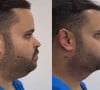 Foto do antes e depois da harmonização facial do ex-BBB Michel