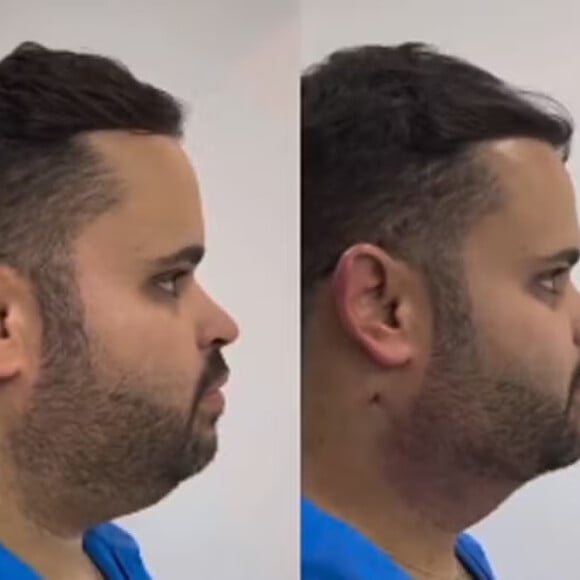 Foto do antes e depois da harmonização facial do ex-BBB Michel