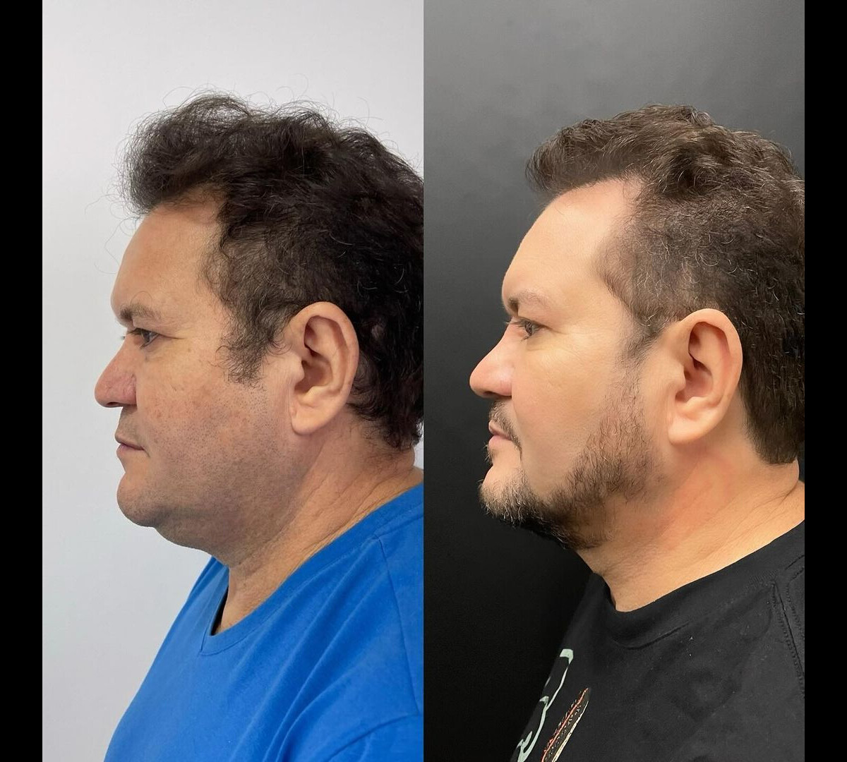 Foto Antes E Depois De Ximbinha Guitarrista Apareceu Completamente Diferente Depois Da