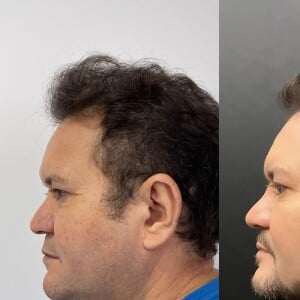 Antes e depois de Ximbinha: guitarrista apareceu completamente diferente depois da harmonização facial