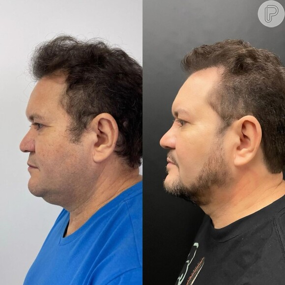 Antes e depois de Ximbinha: guitarrista apareceu completamente diferente depois da harmonização facial