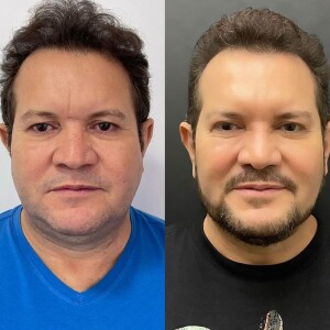 Ximbinha compartilhou o resultado de sua harmonização facial no Instagram e deixou muita gente chocada