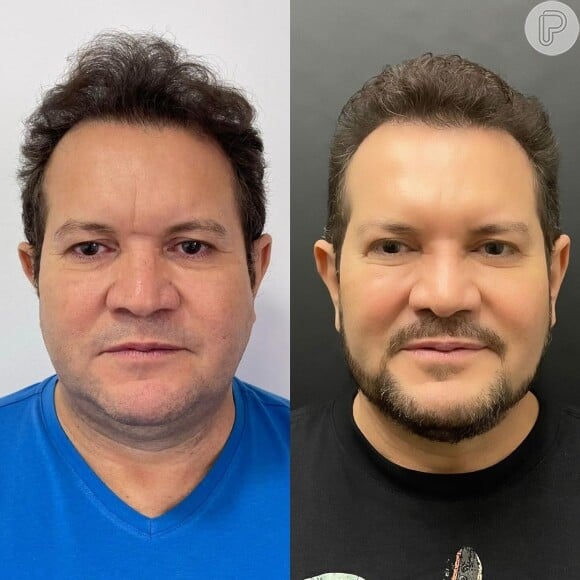 Ximbinha compartilhou o resultado de sua harmonização facial no Instagram e deixou muita gente chocada