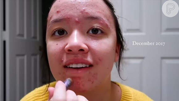 Jornada de mudanças de Alivia D'Andrea começou quando ela ainda tinha 17 anos, com o tratamento de acnes e tentativas de emagrecimento