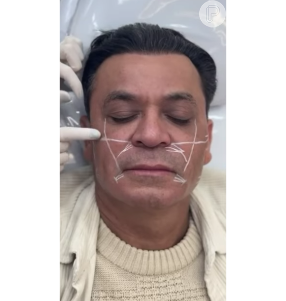 Frank Aguiar compartilhou um vídeo se submetendo aos retoques da harmonização facial
