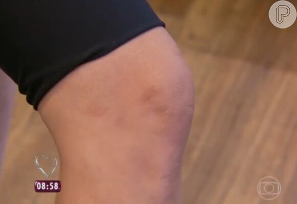 A empresária Flávia Moretti ficou com cicatrizes no joelho após levar tombo de esteira elétrica