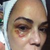 Luiza Brunet mostrou, no 'Fantástico', foto em que aparece com o olho roxo após a briga com Lírio Parisotto