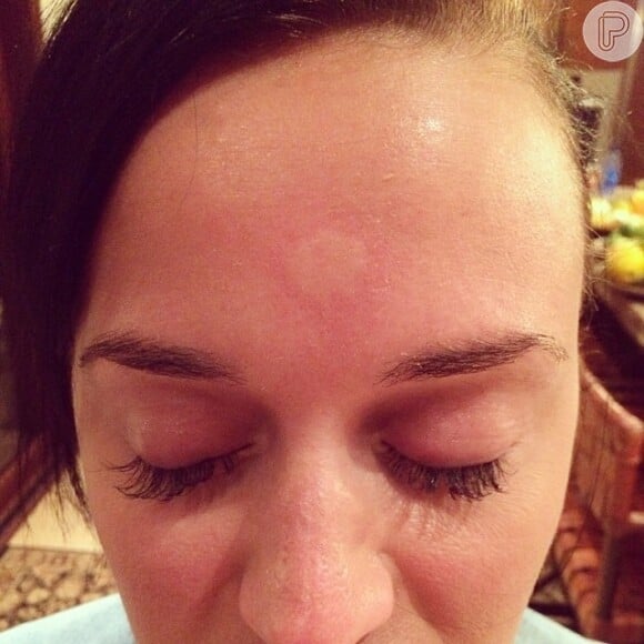 Katy Perry mostra picada de mosquito em sua testa, em 8 de janeiro de 2013