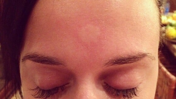 Katy Perry tem alergia ao ser picada por mosquito na testa: 'Meu terceiro olho'