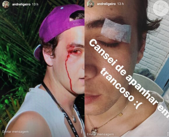 Em sua conta no Instagram, o fotógrafo André Ligeiro mostrou como ficou após a agressão