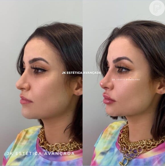 Bianca Andrade passa por harmonização facial e muda o visual