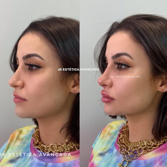 Bianca Andrade passa por harmonização facial e muda o visual