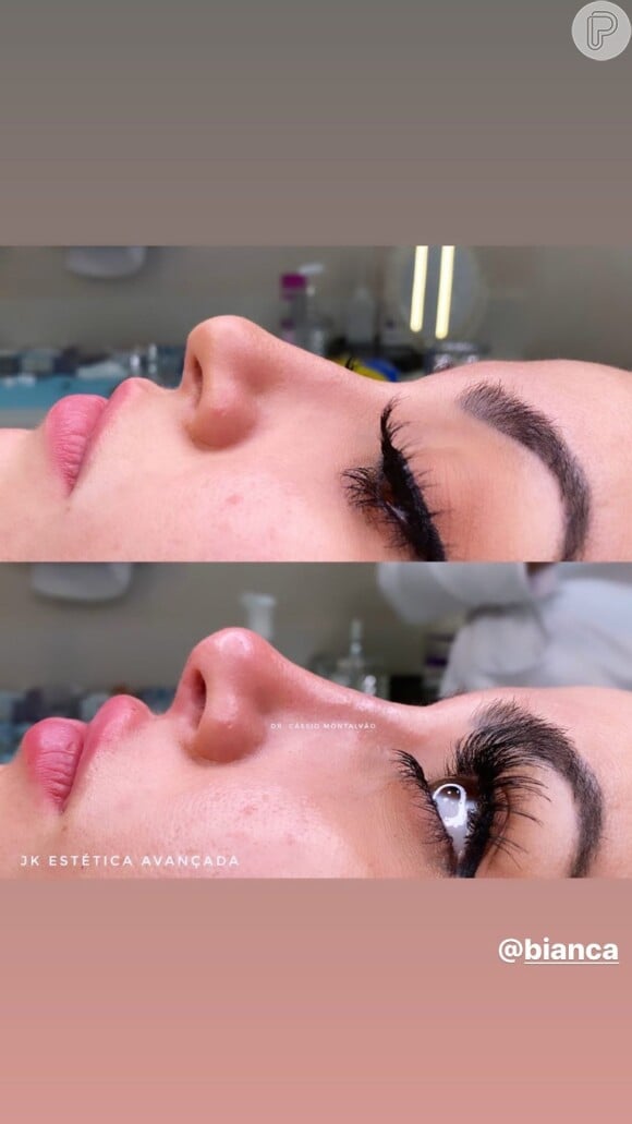 Bianca Andrade faz foto de antes e depois de harmonização facial