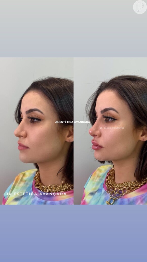 Bianca Andrade faz preenchimento labial e deixa maxilar mais marcado