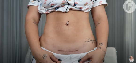 Virgínia mostra cicatriz da cesariana para os seguidores e explica que marca só teve pontos internos