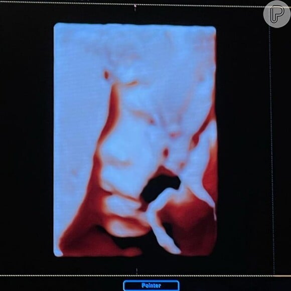 A foto foi tirada de um ultrassom da menina