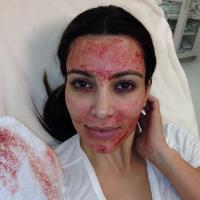 Kim Kardashian mostra o rosto coberto de sangue após procedimento estético