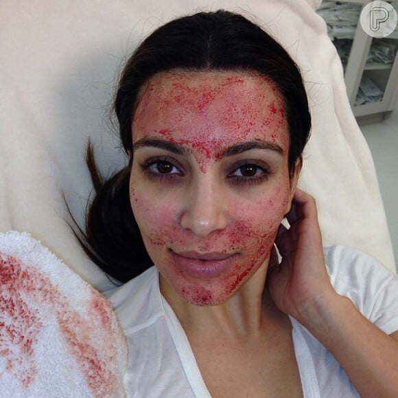 Kim Kardashian mostrou o resultado do 'lifting de vampiro', ao publicar fotos de seu rosto cheio de sangue, na noite deste domingo, 10 de março de 2013