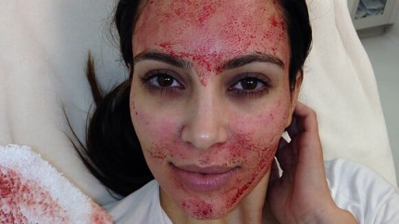 Kim Kardashian mostra o rosto coberto de sangue após procedimento estético