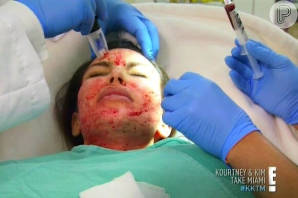 Kim Kardashian aplica o sangue sem plaquetas no rosto, durante o 'lifting de vampiro'