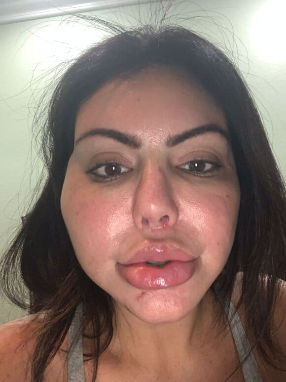 Liziane Gutierrez após a harmonização facial que deu errado