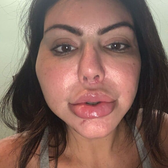 Liziane Gutierrez após a harmonização facial que deu errado