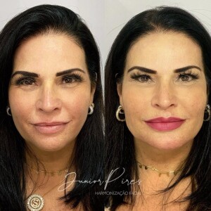 Solange Gomes fez harmonização facial para rejuvenescer o rosto