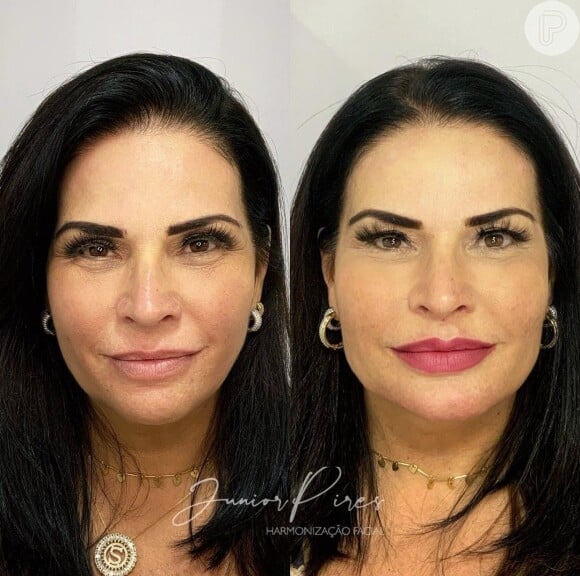 Solange Gomes fez harmonização facial para rejuvenescer o rosto