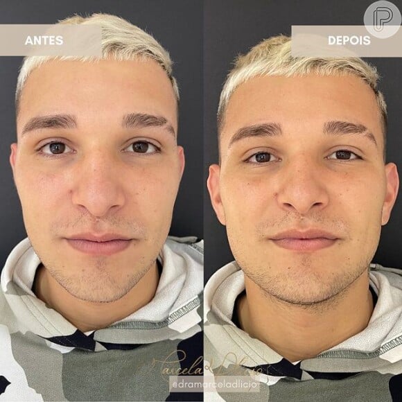 Antes e depois de Rico Melquiades: influenciador revela novo rosto