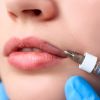 Retirada de preenchimento labial depende da substância que foi inserida nos lábios: a mais popular e segura é o ácido hialurônico