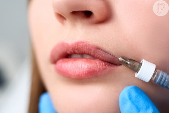 Retirada de preenchimento labial depende da substância que foi inserida nos lábios: a mais popular e segura é o ácido hialurônico