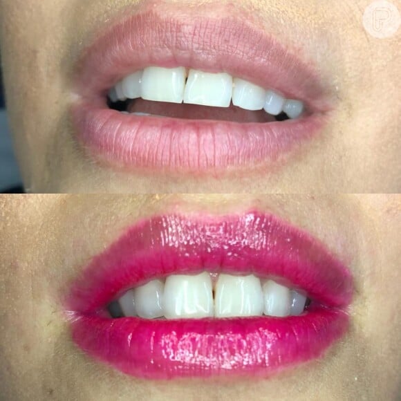 BB Lips: procedimento proporciona efeito lip tint, deixando os lábios com uma leve coloração
