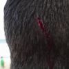 Pedro Scooby cortou a parte de trás da cabeça enquanto surfava